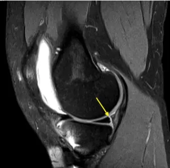 MRI scan of a meniscal tear