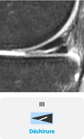 Meniscal tear of the knee as seen on MRI
