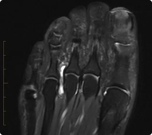 Morton's neuroma MRI