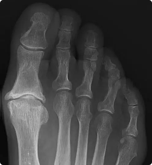 hallux rigidus X-ray
