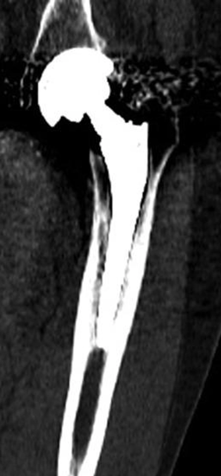 CT scan examination of a loose hip implant