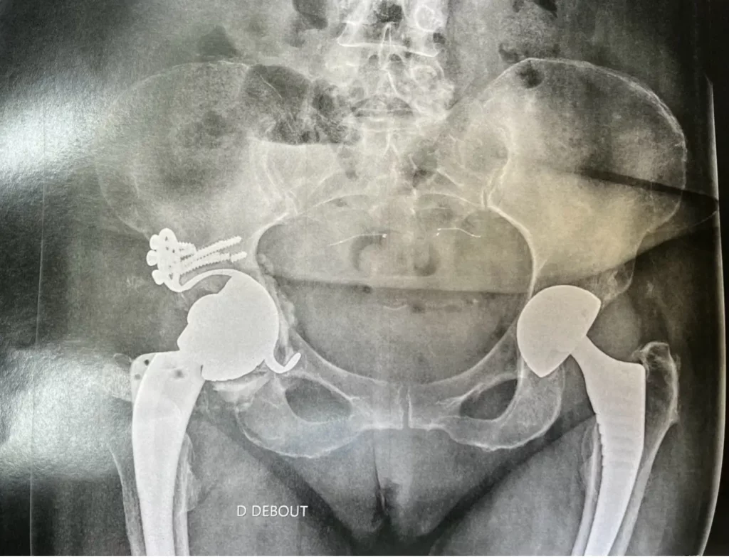 X-ray examination of a loose hip implant