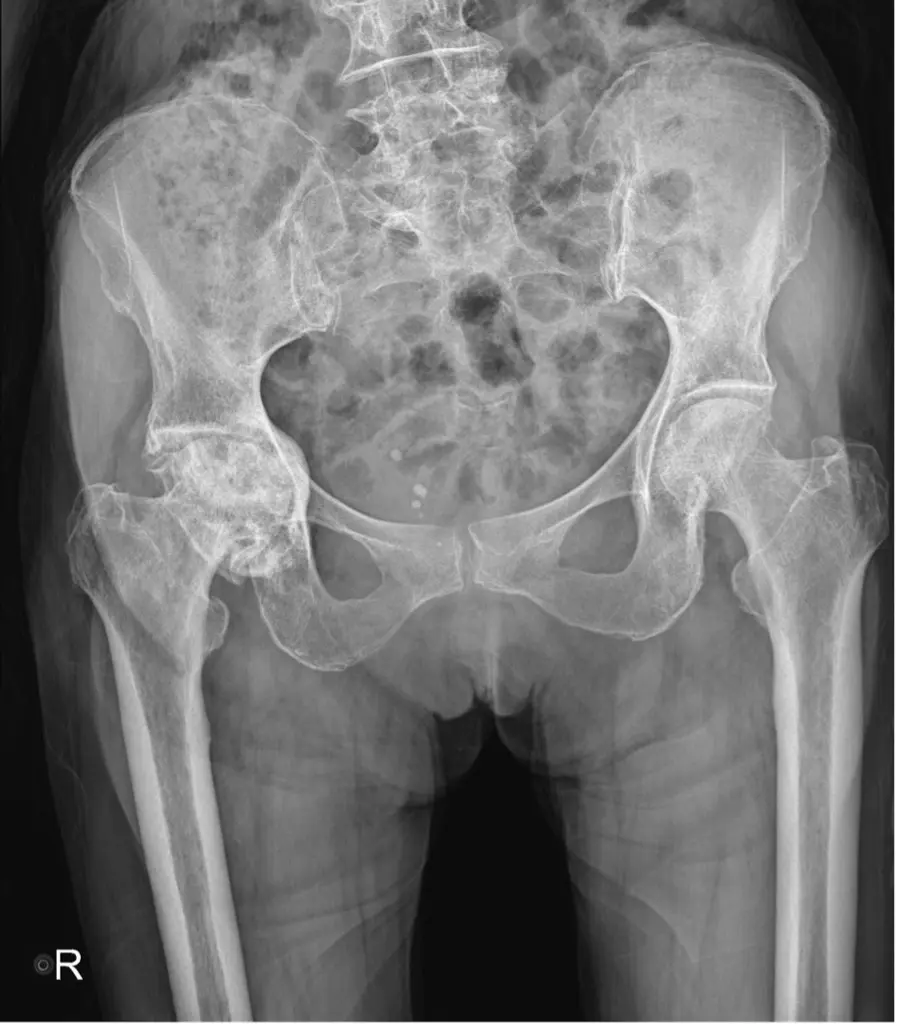 radiographie coxarthrose